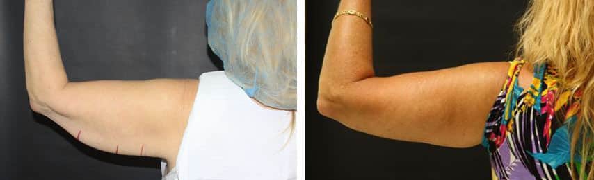 Before and After Image: Brachioplasty - back