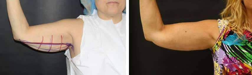 Before and After Image: Brachioplasty - front