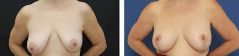 Before and After Image: Breast Augmentation with Mastopexy - front