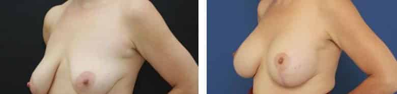 Before and After Image: Breast Augmentation with Mastopexy - left-front-oblique