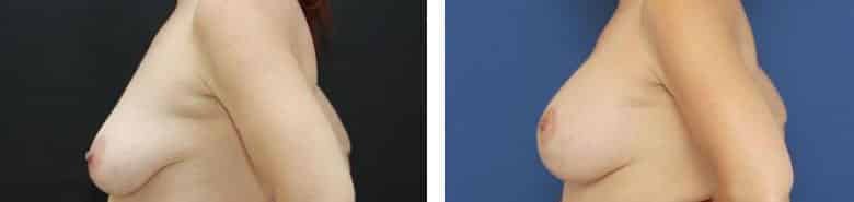 Before and After Image: Breast Augmentation with Mastopexy - left-side