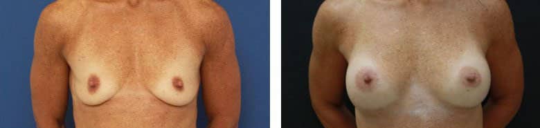 Before and After Image: Breast Augmentation - front
