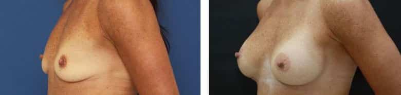 Before and After Image: Breast Augmentation - left-front-oblique