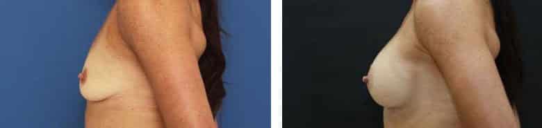 Before and After Image: Breast Augmentation - left-side