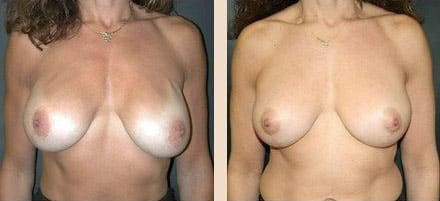 Before and After Image: Breast Implant Revision - front