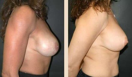 Before and After Image: Breast Implant Revision - right-side