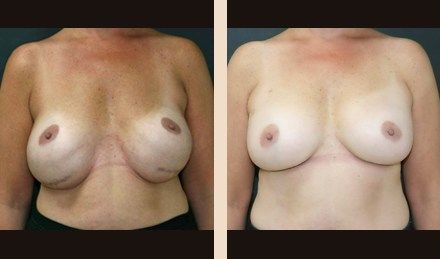 Before and After Image: Breast Implant Revision - front