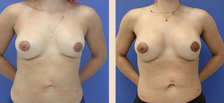 Before and After Image: Breast Implant Revision - front
