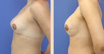 Before and After Image: Breast Implant Revision - left-side