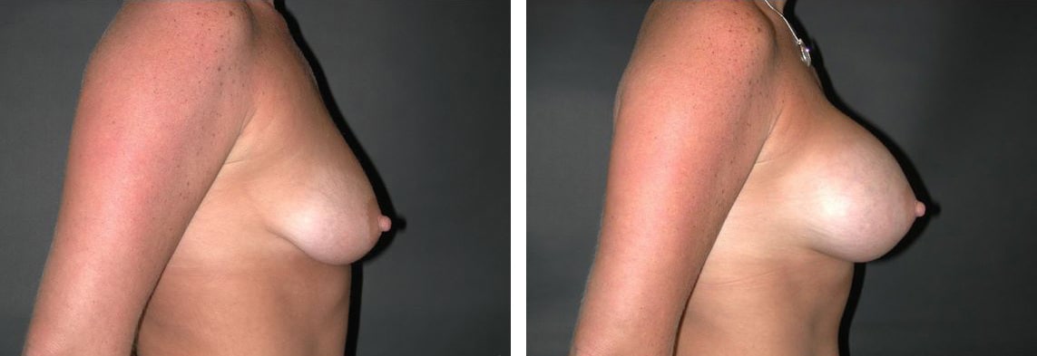 Before and After Image: Breast Augmentation - right-side