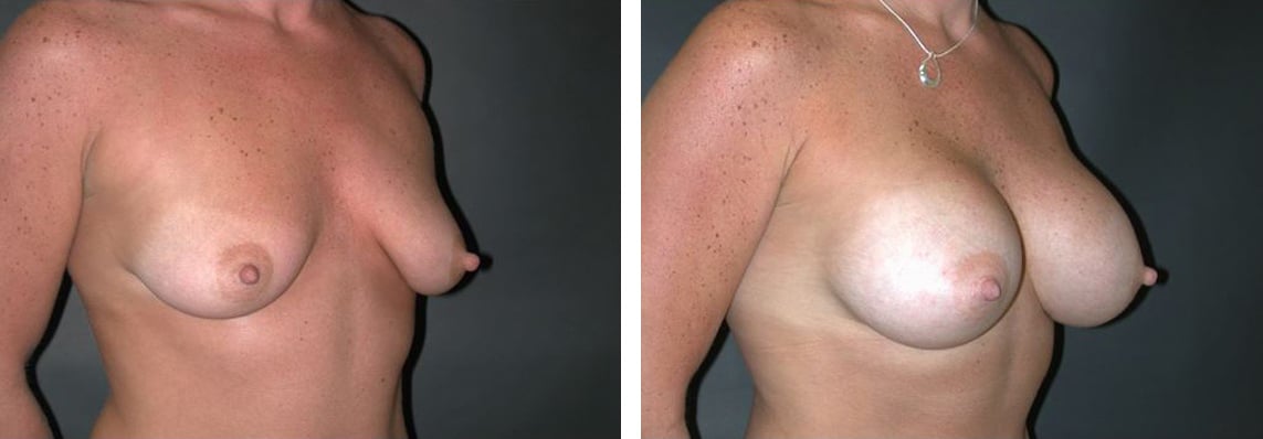 Before and After Image: Breast Augmentation - right-front-oblique