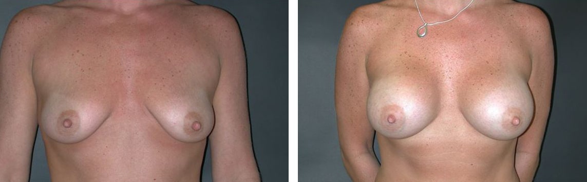 Before and After Image: Breast Augmentation - front
