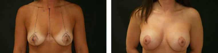 Before and After Image: Breast Augmentation with Mastopexy - front