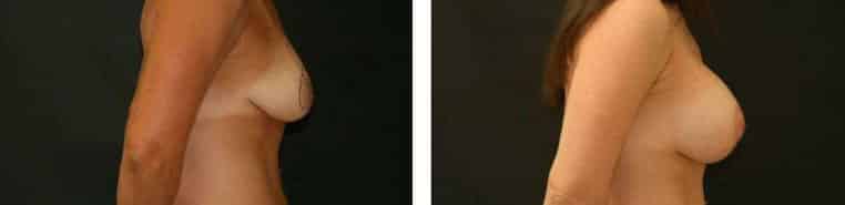 Before and After Image: Breast Augmentation with Mastopexy - right-side