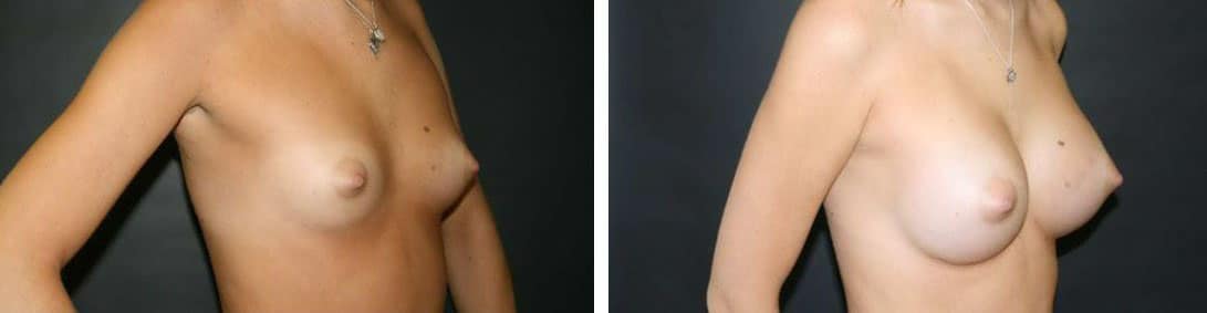 Before and After Image: Breast Augmentation - right-front-oblique