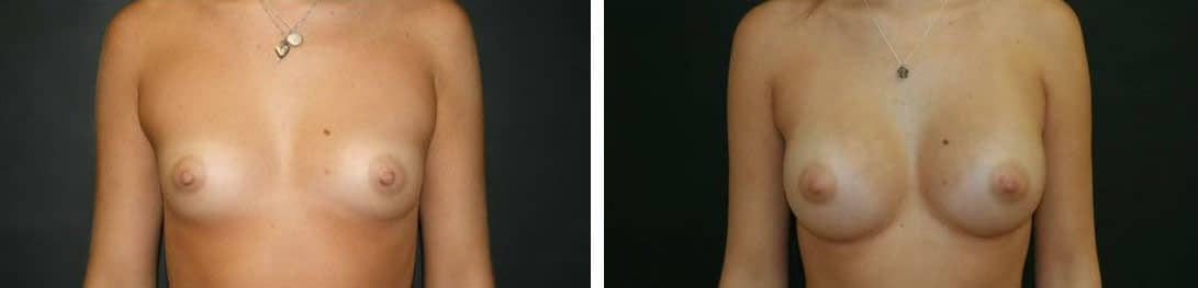 Before and After Image: Breast Augmentation - front