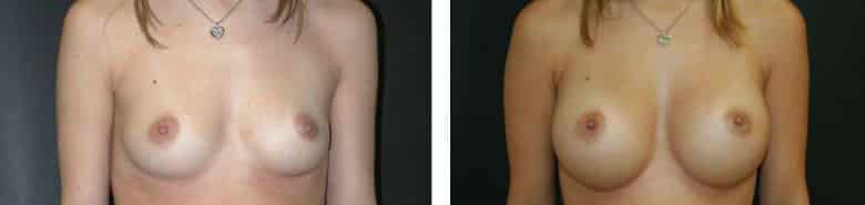 Before and After Image: Breast Augmentation - front