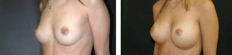 Before and After Image: Breast Augmentation - left-front-oblique