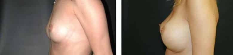 Before and After Image: Breast Augmentation - left-side