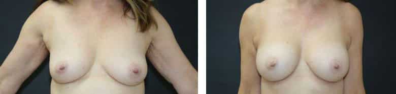 Before and After Image: Breast Augmentation - front