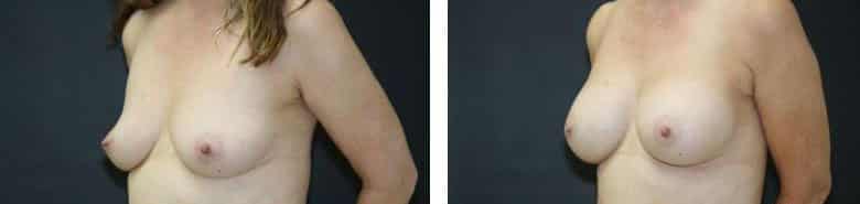 Before and After Image: Breast Augmentation - left-front-oblique