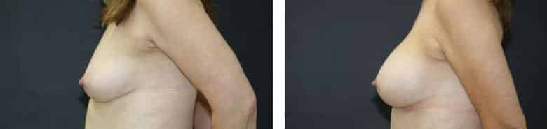 Before and After Image: Breast Augmentation - left-side