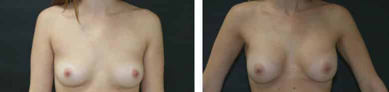 Before and After Image: Breast Augmentation - front