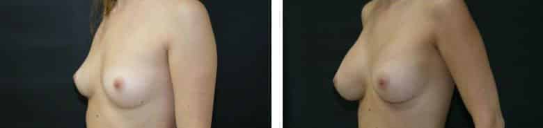 Before and After Image: Breast Augmentation - left-front-oblique