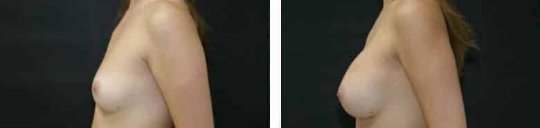 Before and After Image: Breast Augmentation - left-side