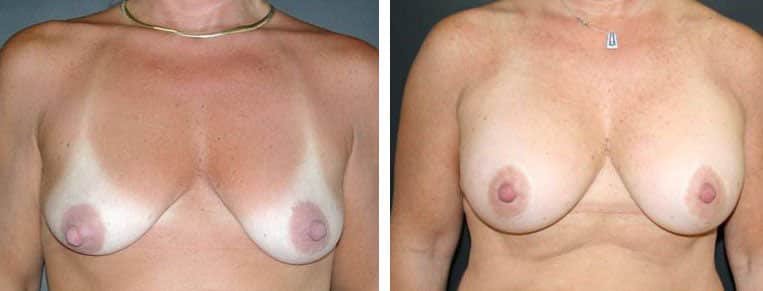 Before and After Image: Breast Augmentation with Mastopexy - front