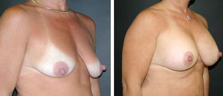 Before and After Image: Breast Augmentation with Mastopexy - right-front-oblique