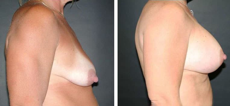 Before and After Image: Breast Augmentation with Mastopexy - right-side