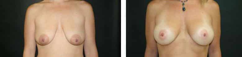 Before and After Image: Breast Augmentation with Mastopexy - front