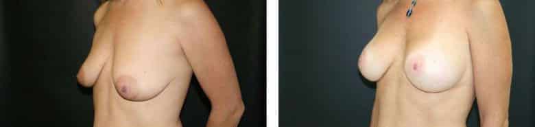 Before and After Image: Breast Augmentation with Mastopexy - left-front-oblique