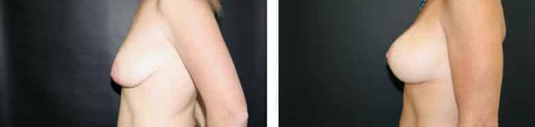 Before and After Image: Breast Augmentation with Mastopexy - left-side