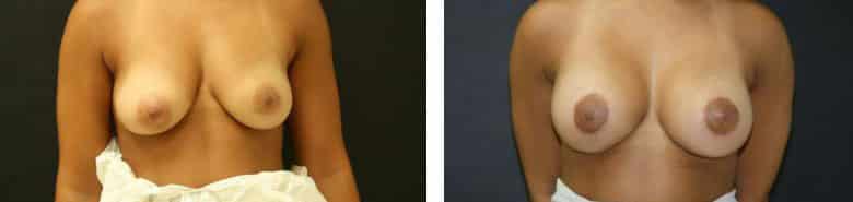 Before and After Image: Breast Augmentation with Mastopexy - front