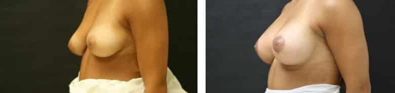 Before and After Image: Breast Augmentation with Mastopexy - left-front-oblique