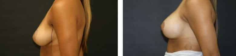 Before and After Image: Breast Augmentation with Mastopexy - left-side