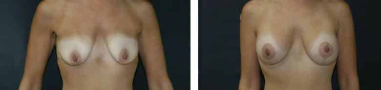 Before and After Image: Breast Augmentation with Mastopexy - front