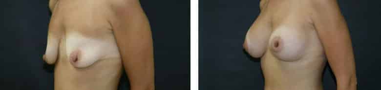 Before and After Image: Breast Augmentation with Mastopexy - left-front-oblique