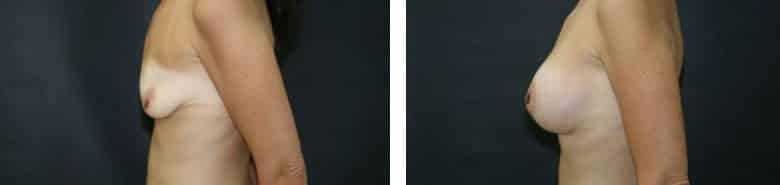 Before and After Image: Breast Augmentation with Mastopexy - left-side