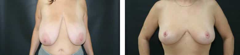 Before and After Image: Breast Reduction - front