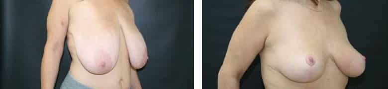 Before and After Image: Breast Reduction - right-front-oblique
