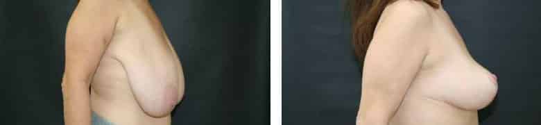 Before and After Image: Breast Reduction - right-side
