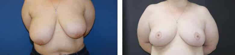 Before and After Image: Breast Reduction - front