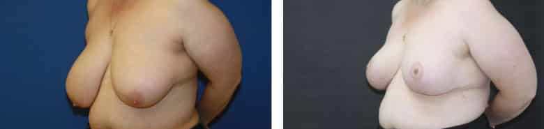 Before and After Image: Breast Reduction - left-front-oblique