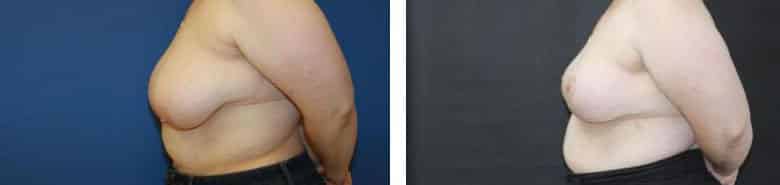 Before and After Image: Breast Reduction - left-side