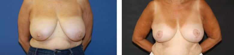 Before and After Image: Breast Reduction - front