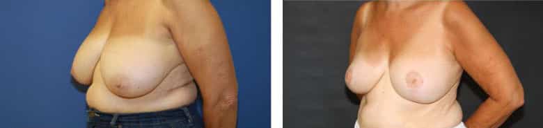 Before and After Image: Breast Reduction - left-front-oblique