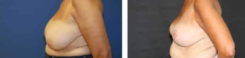 Before and After Image: Breast Reduction - left-side